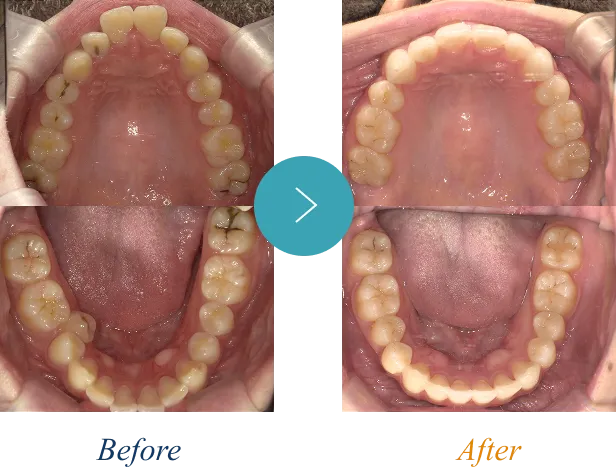 上顎前突(出っ歯)の症例