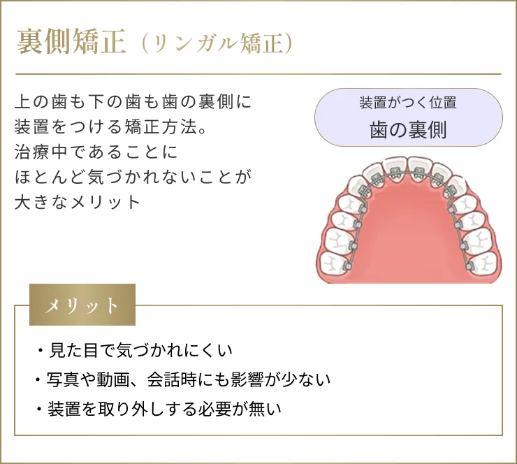 裏側矯正（リンガル矯正）
