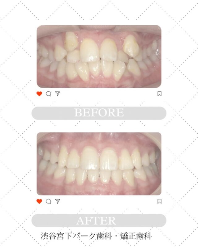 渋谷宮下パーク歯科・矯正歯科です🦷🪥
当院で治療されてる患者様の症例です📷✨

インビザラインのマウスピース矯正をして
アフターのような仕上がりになりました🤍

○使用器具　インビザライン　
○年代　20代
○性別　女性
○期間　2年10ヶ月

これからも自信の持てるお口元をお手伝いさせていただきますので、よろしくお願いします👨🏻‍⚕️

渋谷区でインビザライン矯正治療をお探しでしたら
ぜひ当院へお越しください。

#叢生 #叢生症例
#矯正歯科 #歯科矯正 #矯正治療 #マウスピース矯正 #矯正ライフ #歯並び改善 #噛み合わせ改善 #見えない矯正 #矯正中 #横顔美人矯正 #出っ歯矯正 #受け口矯正 #矯正始めました
#インビザライン #インビザドクター #インビザライン矯正記録 
#目立たない矯正 #渋谷矯正 #矯正歯科 #渋谷 #渋谷歯科 #渋谷歯医者 #渋谷インビザライン #渋谷宮下パーク歯科矯正歯科 #症例写真