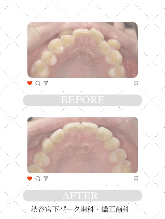 渋谷宮下パーク歯科・矯正歯科です🦷🪥
当院で治療されてる患者様の症例です📷✨

インビザラインのマウスピース矯正をして
アフターのような仕上がりになりました🤍

○使用器具　インビザライン　
○年代　20代
○性別　女性
○期間　2年10ヶ月

これからも自信の持てるお口元をお手伝いさせていただきますので、よろしくお願いします👨🏻‍⚕️

渋谷区でインビザライン矯正治療をお探しでしたら
ぜひ当院へお越しください。

#叢生 #叢生症例
#矯正歯科 #歯科矯正 #矯正治療 #マウスピース矯正 #矯正ライフ #歯並び改善 #噛み合わせ改善 #見えない矯正 #矯正中 #横顔美人矯正 #出っ歯矯正 #受け口矯正 #矯正始めました
#インビザライン #インビザドクター #インビザライン矯正記録 
#目立たない矯正 #渋谷矯正 #矯正歯科 #渋谷 #渋谷歯科 #渋谷歯医者 #渋谷インビザライン #渋谷宮下パーク歯科矯正歯科 #症例写真