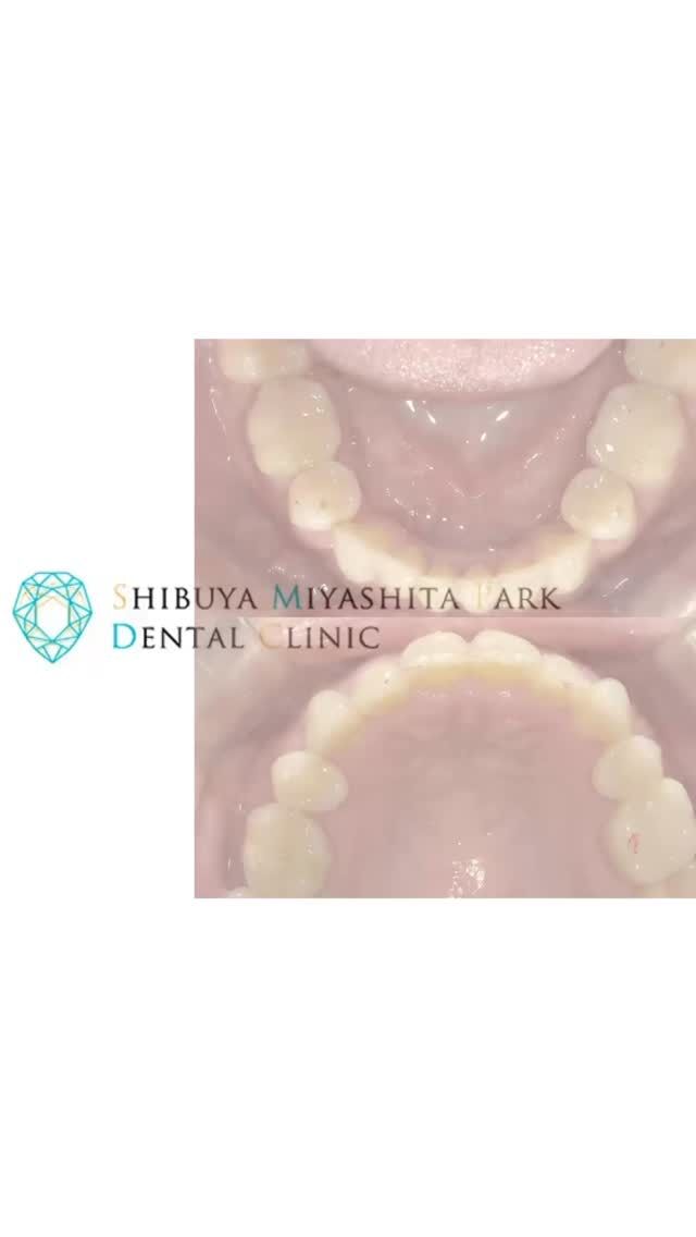 渋谷宮下パーク歯科・矯正歯科です🦷🪥✨

【叢生の症例✨】
Before→Afterでここまで変わります🦷💫

デコボコしていた前歯が、
たった1年8ヶ月で自然で美しいアーチに🤍

○使用器具：インビザライン
○年代：40代女性
○治療期間：1年8ヶ月

患者様一人ひとりに合った治療で、
自信の持てるお口元づくりをお手伝いします👨🏻‍⚕️

渋谷区でインビザライン矯正をご検討の方は
ぜひ当院へご相談ください✨

当院では【無料矯正相談】を実施中です。
ご予約お待ちしております🌟

📍渋谷駅から徒歩1分・宮下パークすぐ
💎インビザライン ダイヤモンドプロバイダー
💬無料カウンセリング受付中！

──────────────
🏥 渋谷宮下パーク歯科・矯正歯科
📍東京都渋谷区渋谷1-24-7 宮下パークビル2階201
⏰ 診療時間：平日11:00〜20:00、土日10:00～17:00
📅 休診日：木曜、祝日、第2・4日曜、日曜診療の翌日月曜

#渋谷矯正歯科 #渋谷歯科 #宮下パーク #渋谷駅近 #矯正歯科 #歯列矯正 #歯並び改善 #インビザライン #ダイヤモンドプロバイダー #目立たない矯正 #マウスピース矯正 #矯正相談無料 #無料カウンセリング #渋谷インビザライン #透明矯正 #矯正治療 #歯並び矯正 #笑顔に自信 #歯科矯正 #歯列矯正はじめました
#叢生 #叢生症例