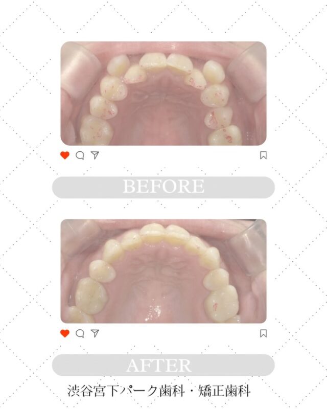 渋谷宮下パーク歯科・矯正歯科です🦷🪥✨

【叢生の症例✨】
Before→Afterでここまで変わります🦷💫

デコボコしていた前歯が、
たった1年8ヶ月で自然で美しいアーチに🤍

○使用器具：インビザライン
○年代：40代女性
○治療期間：1年8ヶ月

患者様一人ひとりに合った治療で、
自信の持てるお口元づくりをお手伝いします👨🏻‍⚕️

渋谷区でインビザライン矯正をご検討の方は
ぜひ当院へご相談ください✨

当院では【無料矯正相談】を実施中です。
ご予約お待ちしております🌟

📍渋谷駅から徒歩1分・宮下パークすぐ
💎インビザライン ダイヤモンドプロバイダー
💬無料カウンセリング受付中！

──────────────
🏥 渋谷宮下パーク歯科・矯正歯科
📍東京都渋谷区渋谷1-24-7 宮下パークビル2階201
⏰ 診療時間：平日11:00〜20:00、土日10:00～17:00
📅 休診日：木曜、祝日、第2・4日曜、日曜診療の翌日月曜

#渋谷矯正歯科 #渋谷歯科 #宮下パーク #渋谷駅近 #矯正歯科 #歯列矯正 #歯並び改善 #インビザライン #ダイヤモンドプロバイダー #目立たない矯正 #マウスピース矯正 #矯正相談無料 #無料カウンセリング #渋谷インビザライン #透明矯正 #矯正治療 #歯並び矯正 #笑顔に自信 #歯科矯正 #歯列矯正はじめました
#叢生 #叢生症例