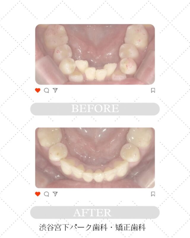 渋谷宮下パーク歯科・矯正歯科です🦷🪥✨

【叢生の症例✨】
Before→Afterでここまで変わります🦷💫

デコボコしていた前歯が、
たった1年8ヶ月で自然で美しいアーチに🤍

○使用器具：インビザライン
○年代：40代女性
○治療期間：1年8ヶ月

患者様一人ひとりに合った治療で、
自信の持てるお口元づくりをお手伝いします👨🏻‍⚕️

渋谷区でインビザライン矯正をご検討の方は
ぜひ当院へご相談ください✨

当院では【無料矯正相談】を実施中です。
ご予約お待ちしております🌟

📍渋谷駅から徒歩1分・宮下パークすぐ
💎インビザライン ダイヤモンドプロバイダー
💬無料カウンセリング受付中！

──────────────
🏥 渋谷宮下パーク歯科・矯正歯科
📍東京都渋谷区渋谷1-24-7 宮下パークビル2階201
⏰ 診療時間：平日11:00〜20:00、土日10:00～17:00
📅 休診日：木曜、祝日、第2・4日曜、日曜診療の翌日月曜

#渋谷矯正歯科 #渋谷歯科 #宮下パーク #渋谷駅近 #矯正歯科 #歯列矯正 #歯並び改善 #インビザライン #ダイヤモンドプロバイダー #目立たない矯正 #マウスピース矯正 #矯正相談無料 #無料カウンセリング #渋谷インビザライン #透明矯正 #矯正治療 #歯並び矯正 #笑顔に自信 #歯科矯正 #歯列矯正はじめました
#叢生 #叢生症例